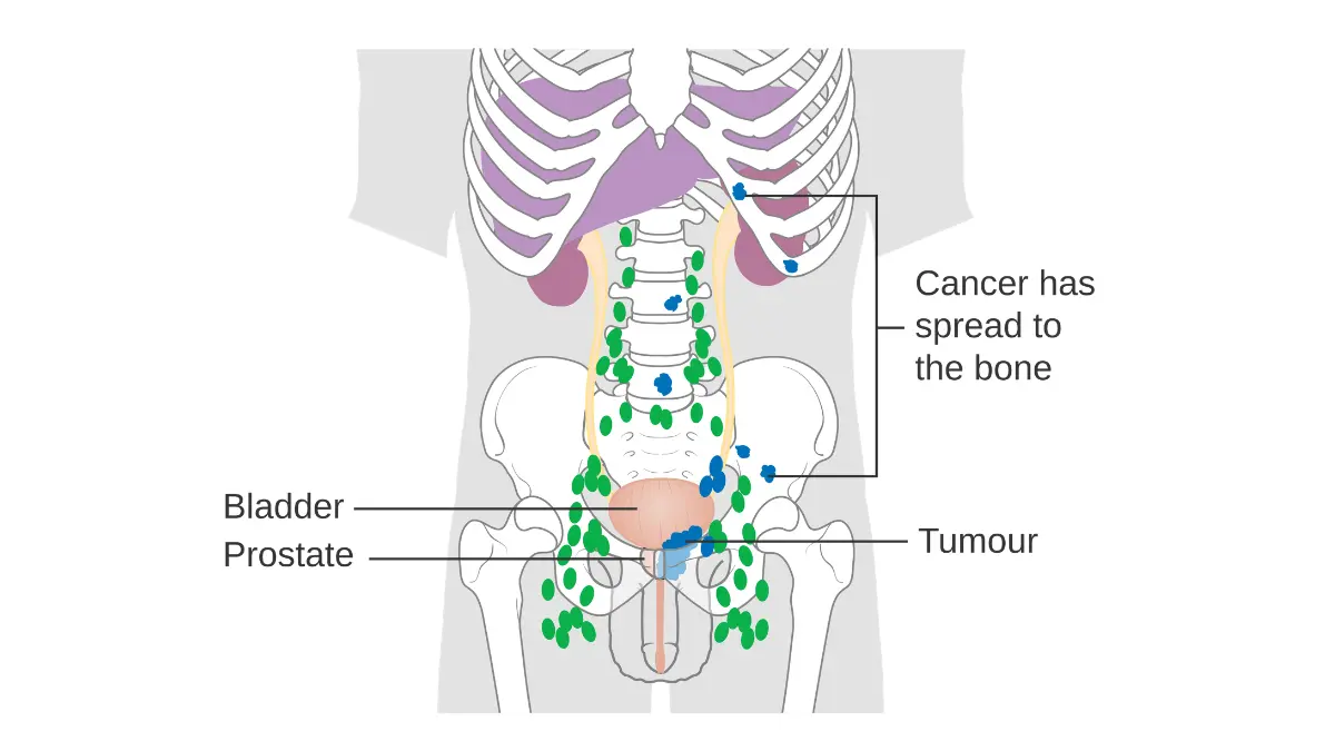 stage 4 prostate cancer medical illustration showing prostate cancer spread to the bones in advanced metastatic disease.
