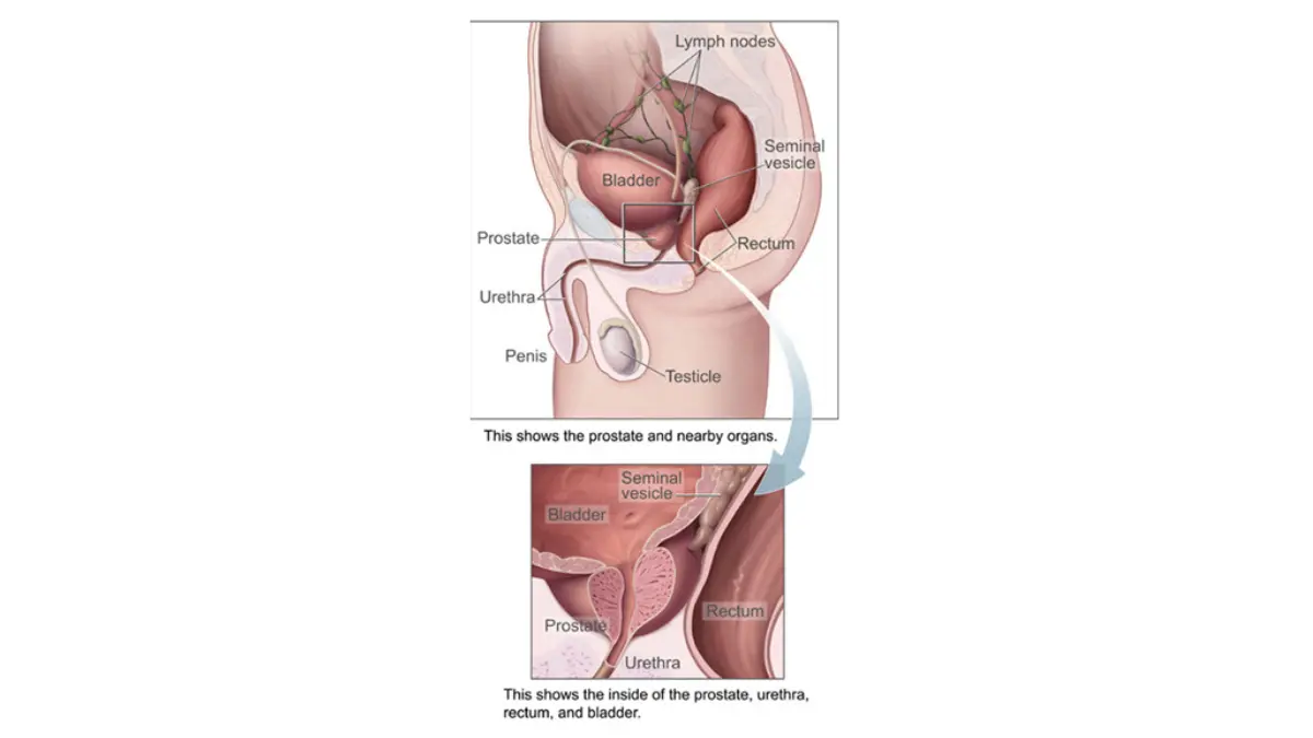 stage 4 prostate cancer sagittal anatomy image showing the prostate and bladder in side view with surrounding pelvic structures.