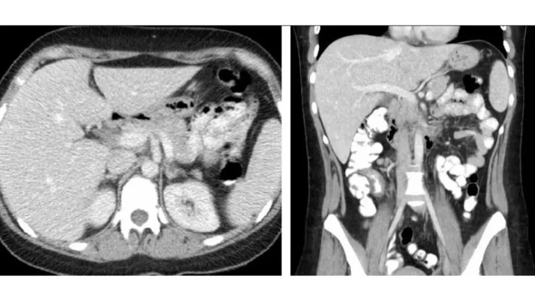 Virtual Colonoscopy CT scan showing normal abdomen and pelvis imaging.