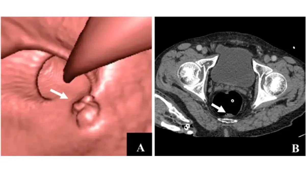 3D Virtual Colonoscopy scan (CT colonography) revealing a rectal mass in the colon.