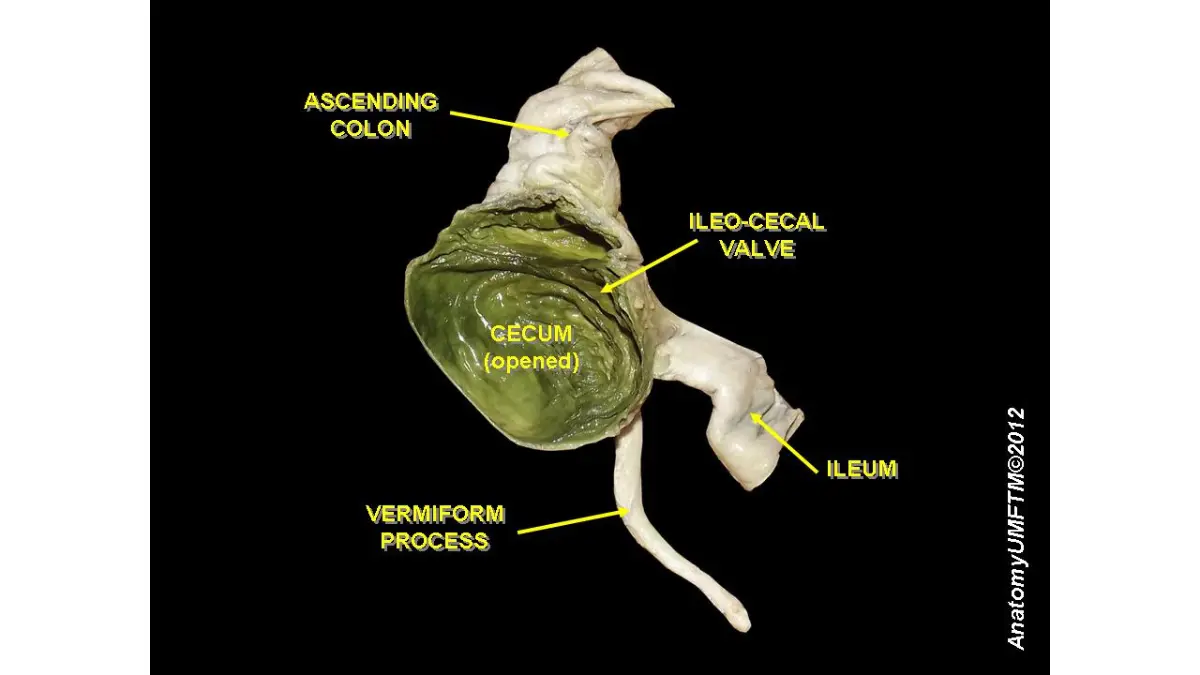 What Happens During a Colonoscopy: cecum and ileocecal valve image showing the landmark used to confirm full scope insertion.