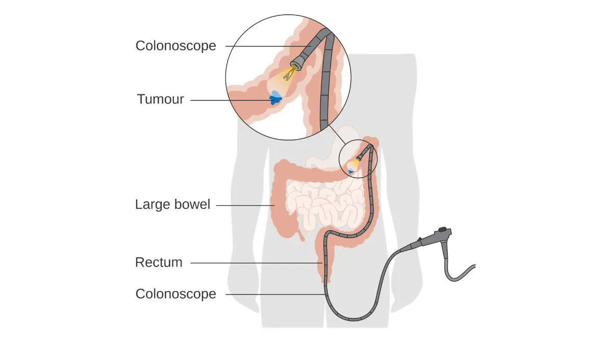 What Happens During a Colonoscopy: bowel lesion and removal diagram illustrating how abnormal tissue may be treated during the procedure.