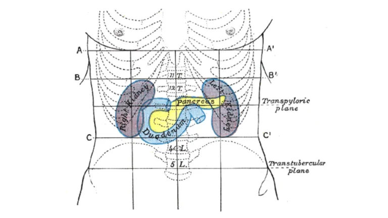 Whipple procedure surface anatomy illustration showing the upper abdomen and the area of the pancreas and duodenum.