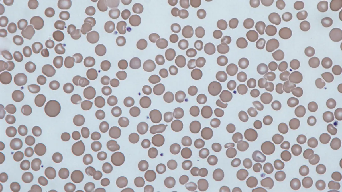 Microscopic blood smear showing anisocytosis where red blood cells vary significantly in size, causing a high RDW.