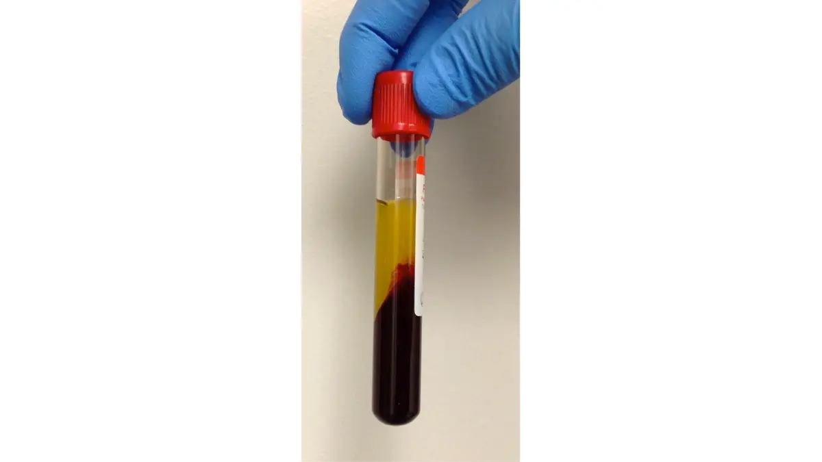 Labeled clinical laboratory sample container highlighting the plasma fluid index used to cross-reference CBC normal ranges in pregnancy.