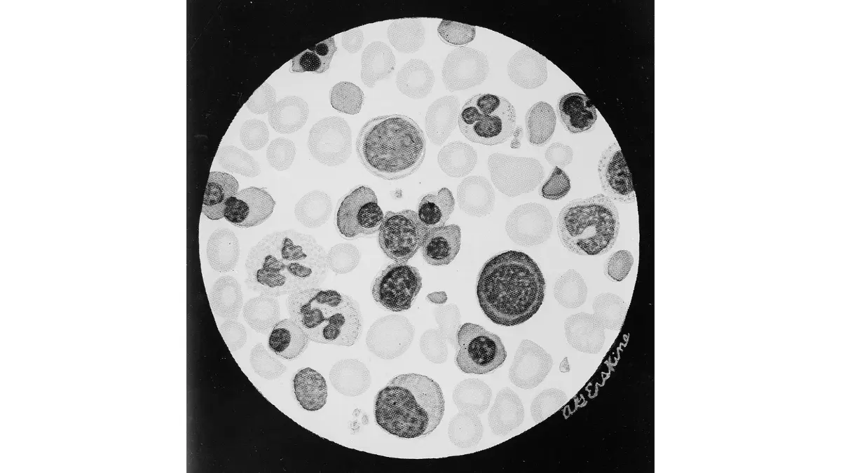 High-magnification clinical microscopic image of a Giemsa-stained peripheral blood smear used for verification of an At-Home CBC Test.