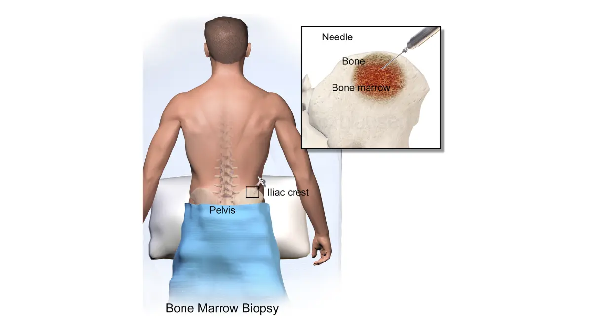 Medical cross-section illustration showing a biopsy needle passing through cortical bone into spongy marrow to collect samples for leukemia testing.