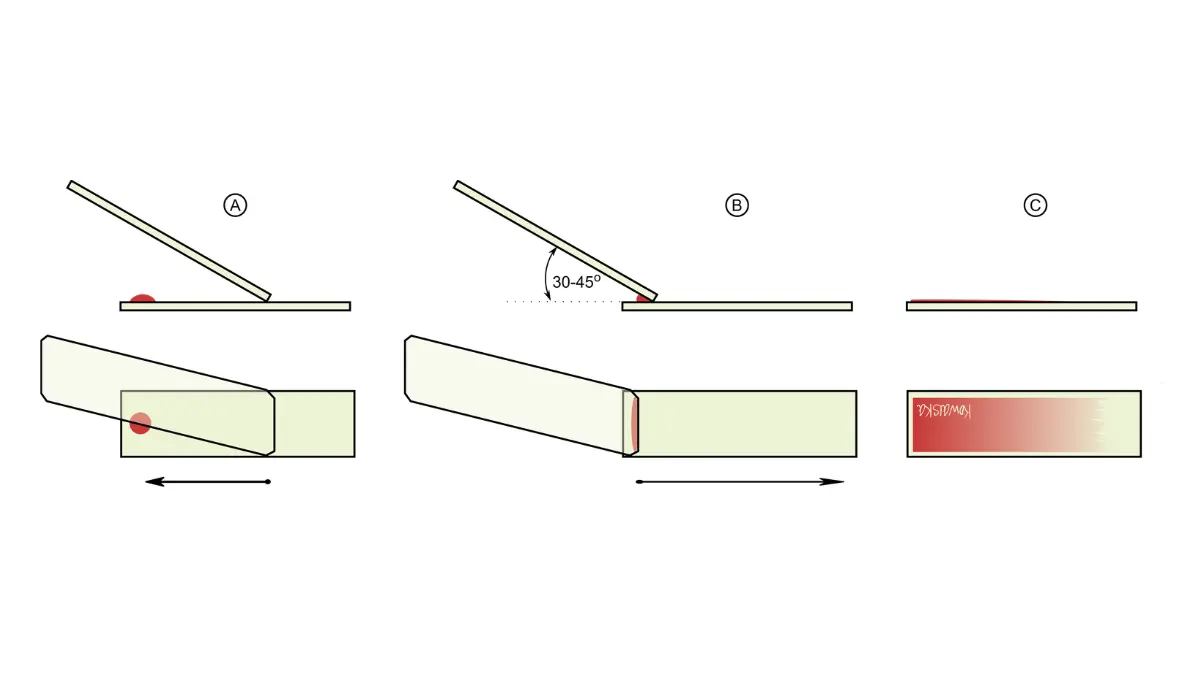 A vector schematic showing the clinical process of preparing a blood smear slide to investigate cell morphology and determine can a CBC detect cancer.
