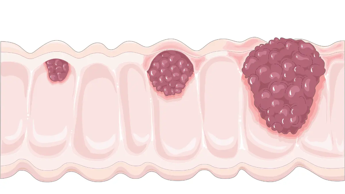 Medical anatomy diagram showing stages of colon wall tissue invasion, clarifying why internal bleeding limits how well can a CBC detect cancer.