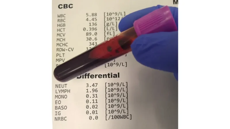 Complete blood count laboratory analyzer report illustrating a CBC Normal Range Chart layout with reference values.