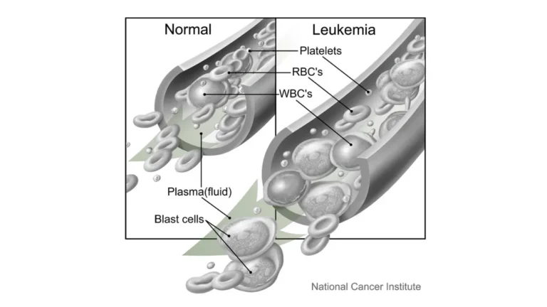 Medical vector illustration showing normal blood cells versus abnormal leukemia cells during a clinical CBC test breakdown.