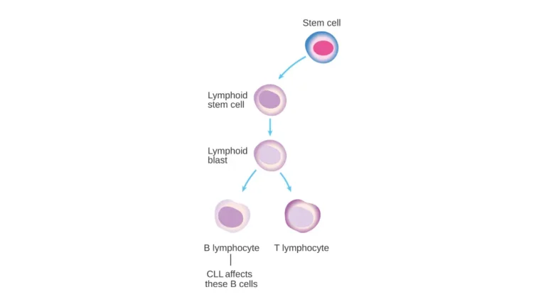 Medical vector chart detailing normal white blood cell differentiation pathways disrupted by chronic lymphocytic leukemia.