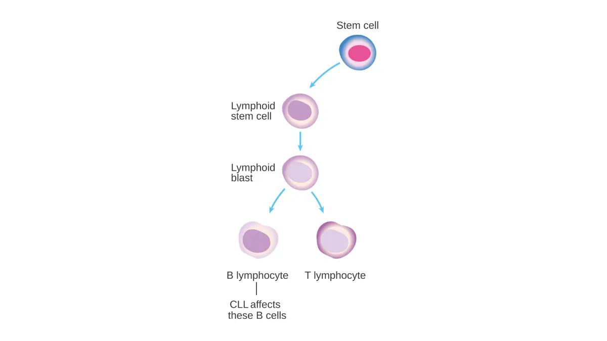 Medical vector chart detailing normal white blood cell differentiation pathways disrupted by chronic lymphocytic leukemia.
