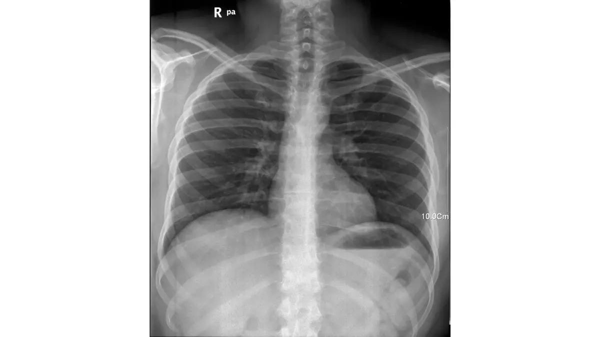 Diagnostic chest X-ray illustrating clear lung fields during an Immigration or Work Physical.