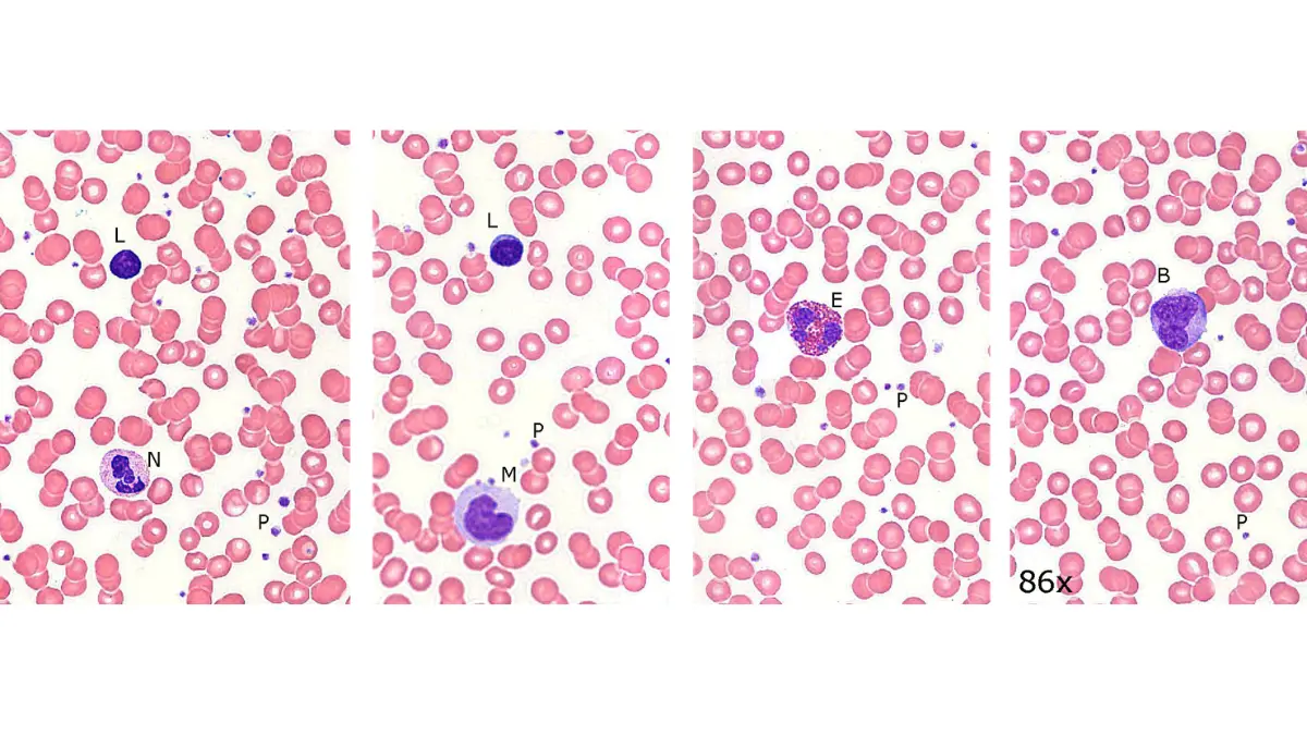 Labeled clinical blood smear diagram showing lymphocytes, monocytes, neutrophils, and platelets used during complete blood count evaluation for leukemia.