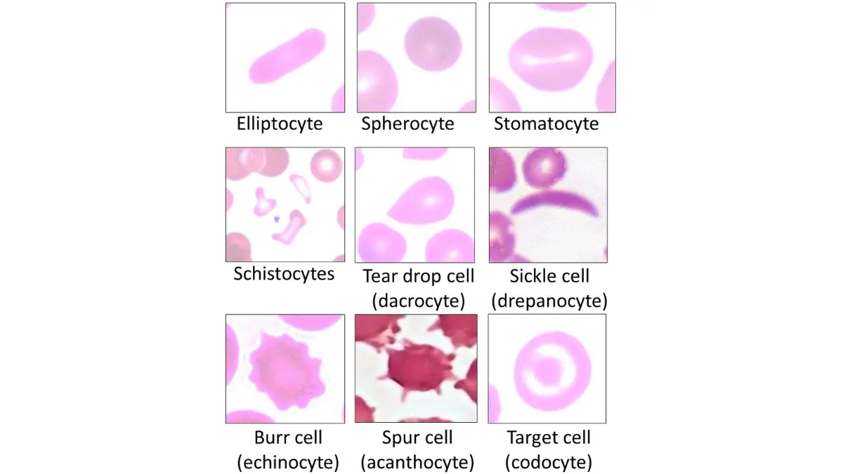 Medical chart tracking abnormal red blood cell types to verify why a diagnostic CBC covered by insurance applies to deductibles.