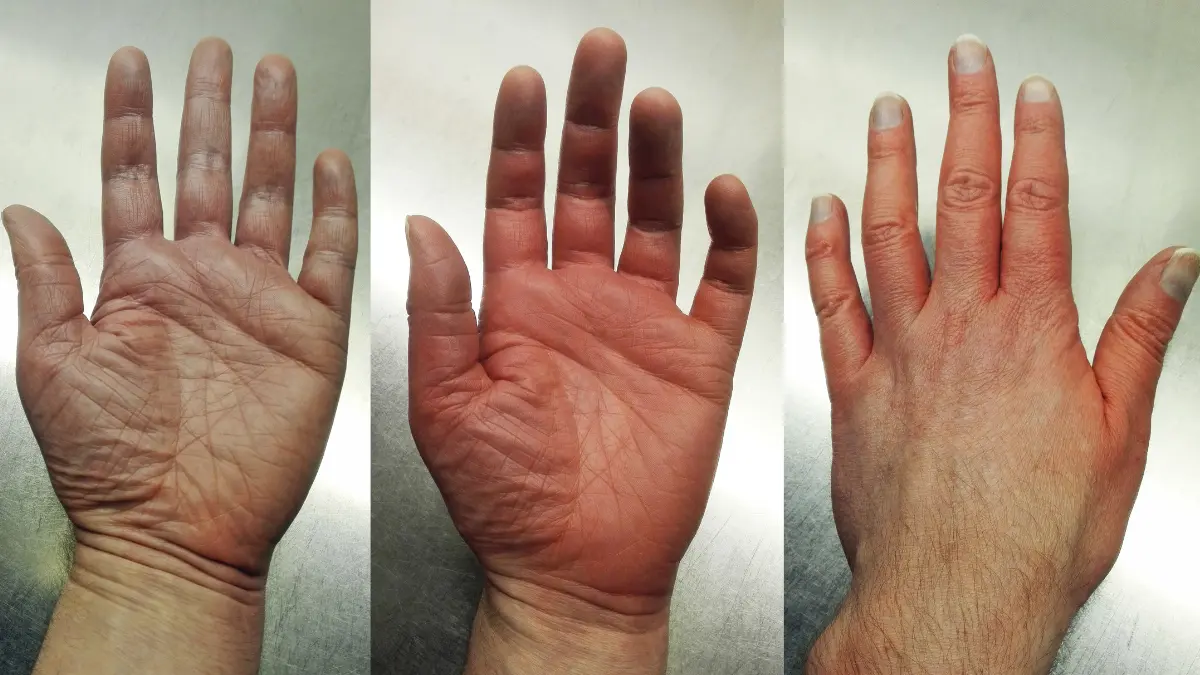 Clinical photo of a patient's hand exhibiting redness and vascular dilation from erythromelalgia, a symptom tied to a high platelet count.