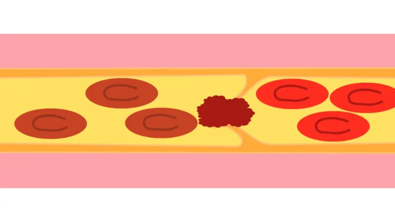A medical vector diagram illustrating a blood vessel lumen with a high platelet count causing cellular aggregation and thrombus formation.
