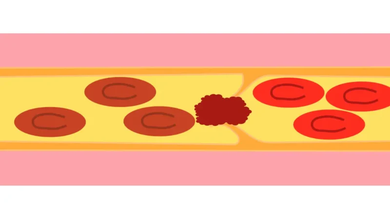 A medical vector diagram illustrating a blood vessel lumen with a high platelet count causing cellular aggregation and thrombus formation.