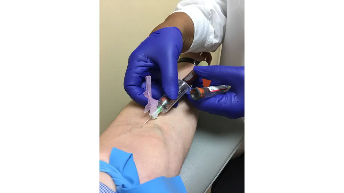 Clear view of blood extraction into a BD Vacutainer assembly showing plasma volume flow relevant to a CBC Test.