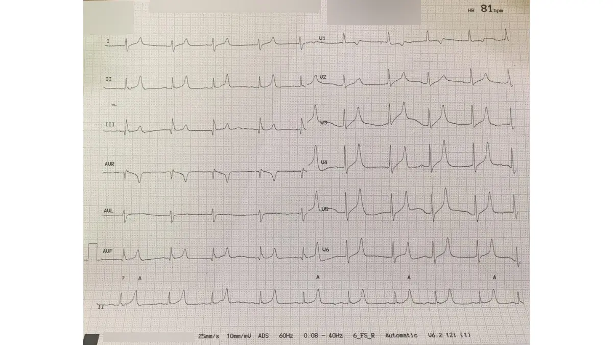 Real clinical ECG strip readout showcasing diagnostic peaked T waves related to severe high potassium causes.