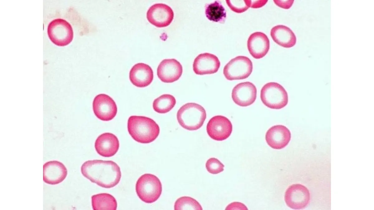 Vector diagram mapping out hypochromic microcytic anemia where small, pale red blood cells contribute to an altered RDW pattern.