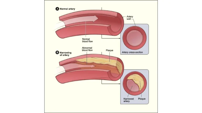 A vascular cross-section diagram showing the progression of lipid buildup within an artery wall as screened by an annual blood work panel.