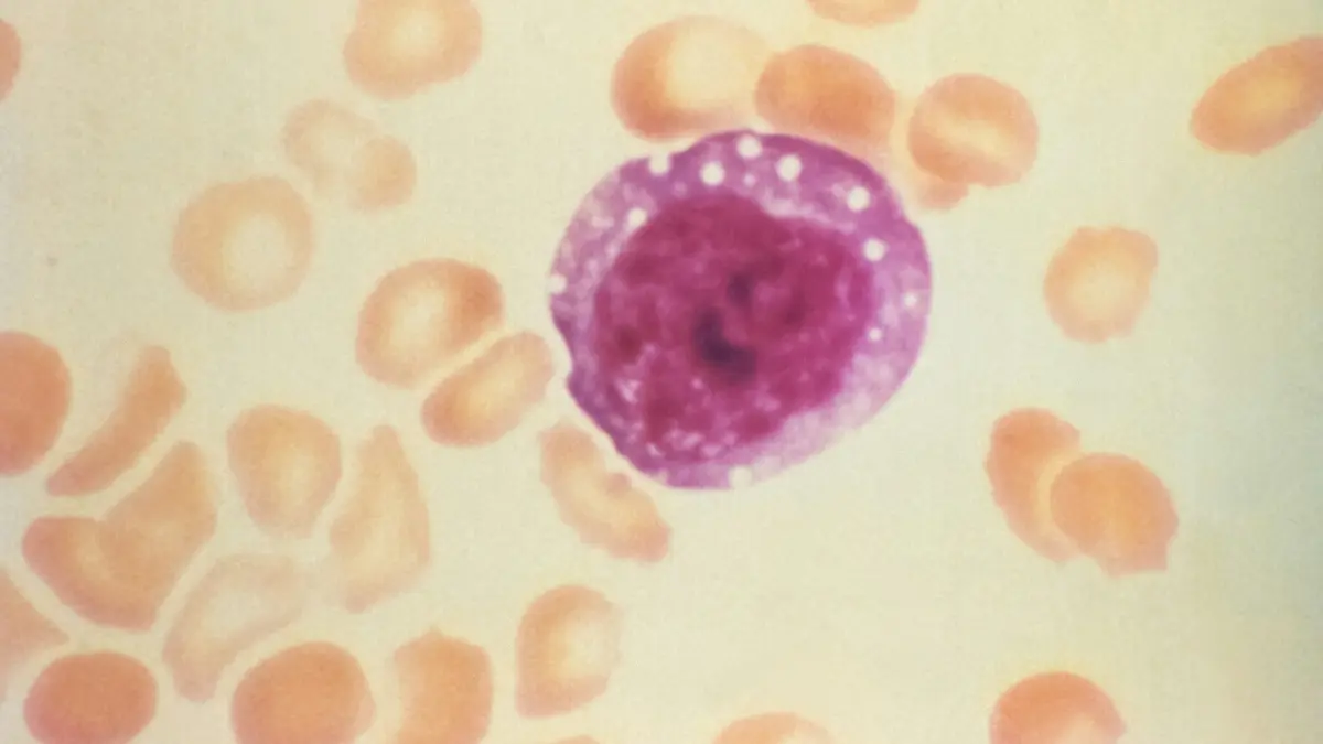 Clinical blood slide showing enlarged macrocytic cells that shift mean corpuscular volume and disrupt standard RDW metrics.