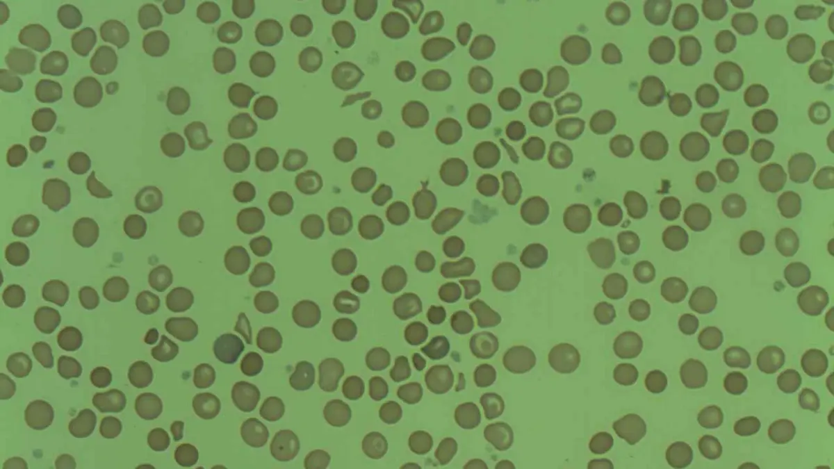 Peripheral blood film showing enlarged macrocytes identified during an elevated MCV blood test.