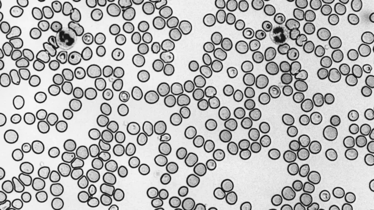 A medical microscopic visualization of human red blood cells used to interpret an abnormal MCV blood test.