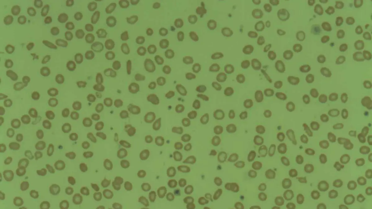 Lab sample presentation demonstrating microcytosis where cell diameter falls below normal limits, shifting RDW distribution curves.