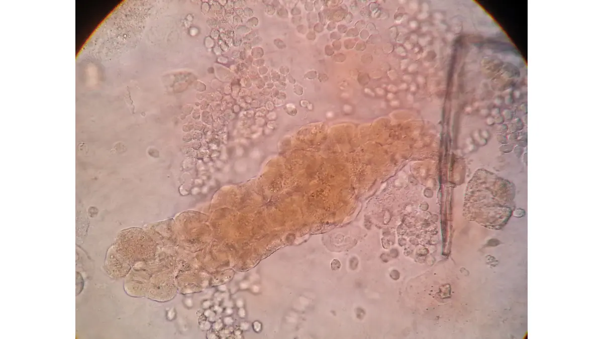 Microscopic view of renal epithelial cell cast in urine sediment during an Immigration or Work Physical.