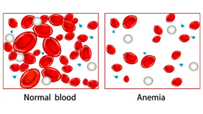 A medical vector diagram comparing normal blood flow with high red blood cell counts against low hemoglobin anemia blood flow with fewer red blood cells.