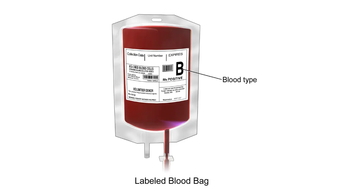 A clean vector graphic of a packed red blood cell bag used in clinical treatments for severe anemia or an abnormal CBC showing low hemoglobin.