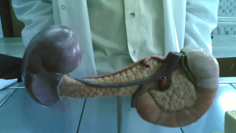 Posterior view of a medical organ model illustrating the bile duct and pancreatic duct connection, a source of blockages managed by an emergency Pancreatic Cancer Treatment Center.