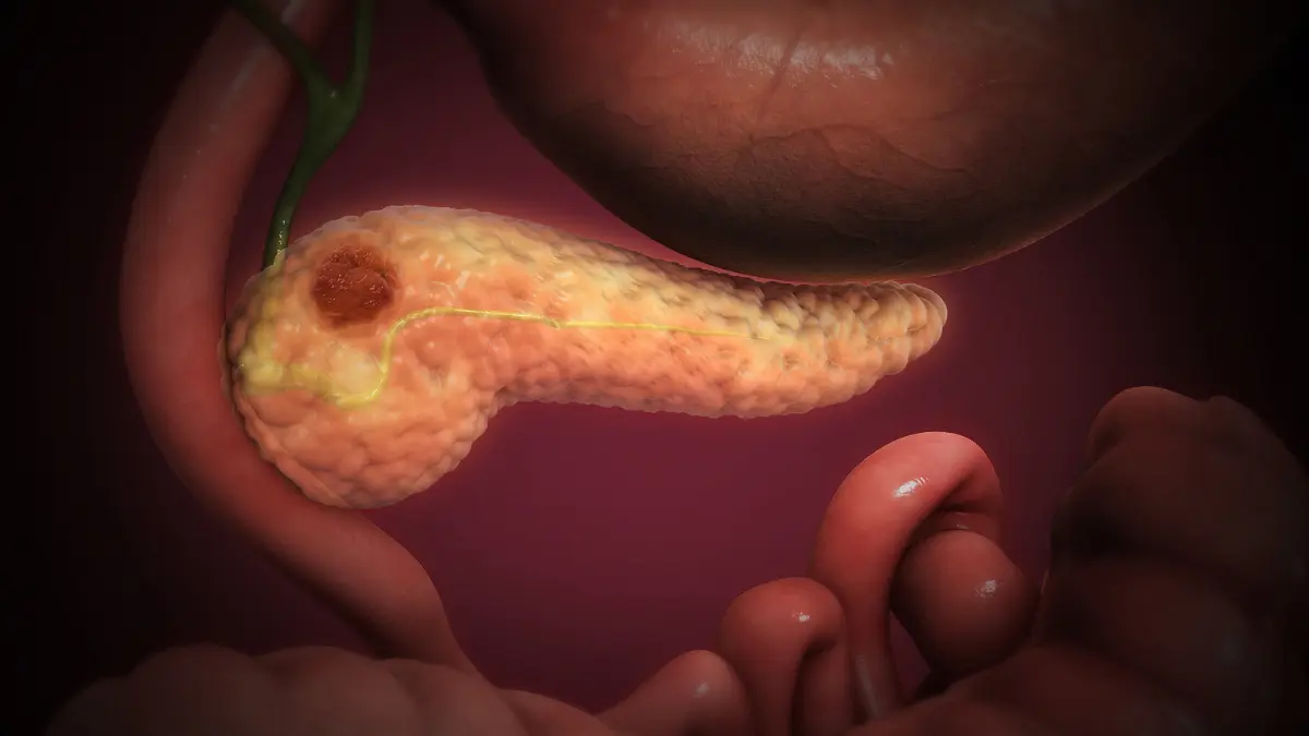 3D medical illustration showing tumor mass formation within internal tissues to educate a Pancreatic Cancer Caregiver.