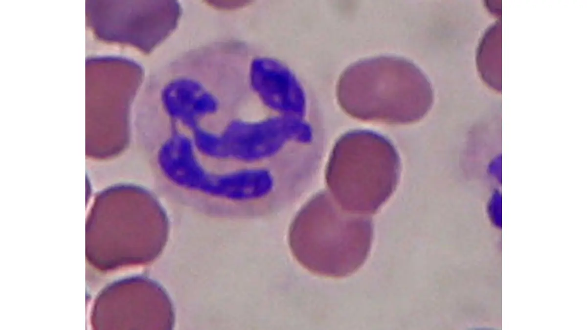 A high-definition peripheral blood smear under a microscope showing red blood cells alongside a segmented cell to identify Low Neutrophils.