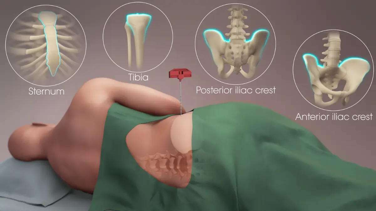 Posterior human hip vector layout marking the exact anatomical site on the iliac crest for bone marrow aspiration to confirm leukemia.