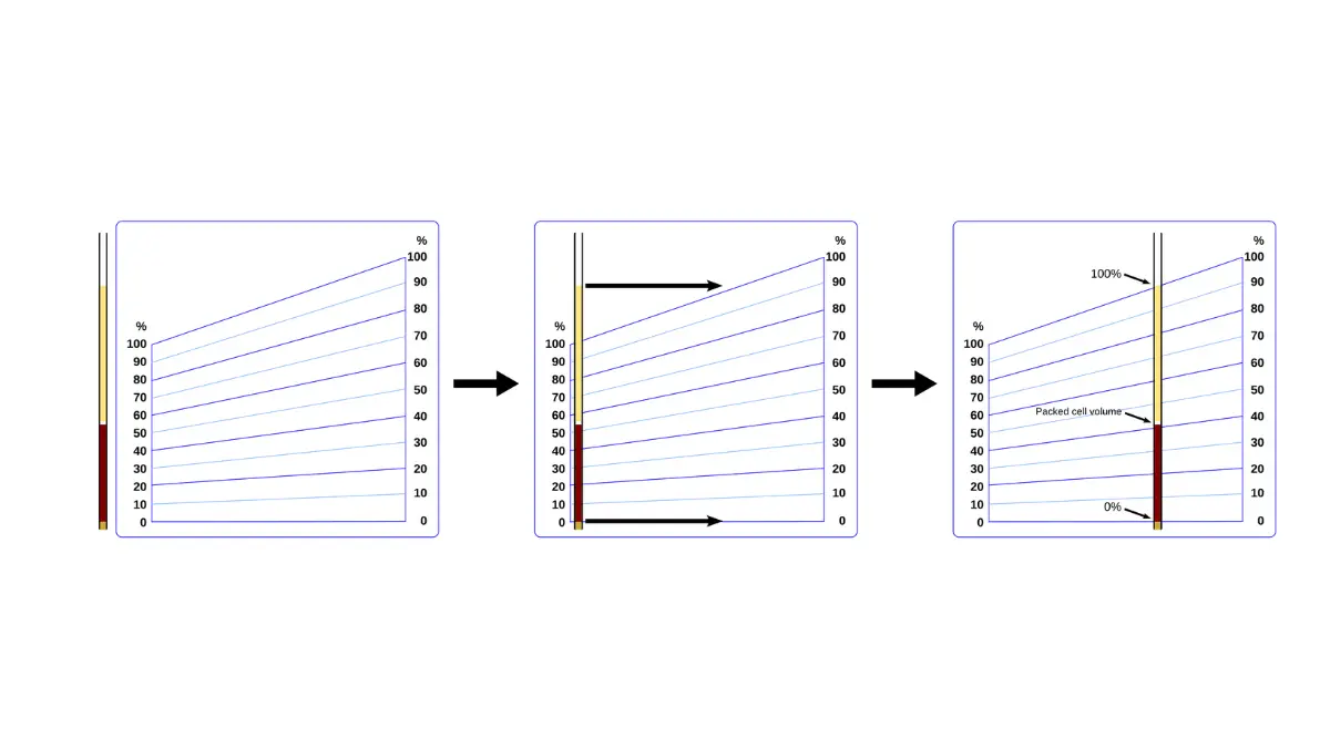 Vector illustration showing a spun capillary reader analyzing blood volume proportions for Hematocrit vs Hemoglobin evaluation.