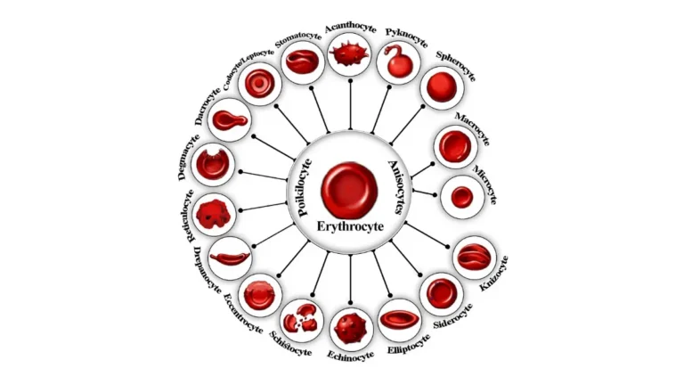 A detailed medical illustration showing various structural red blood cell disorders and size variations relevant to an elevated RDW.