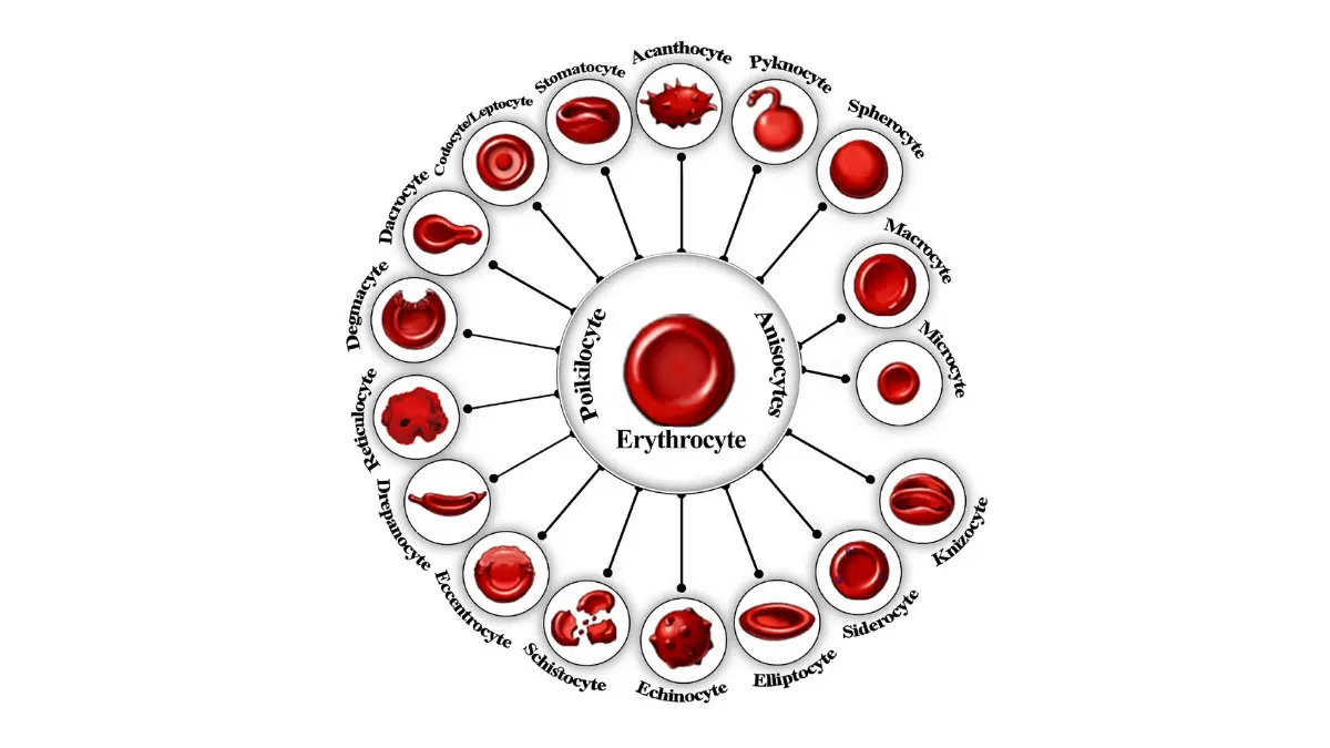 A detailed medical illustration showing various structural red blood cell disorders and size variations relevant to an elevated RDW.