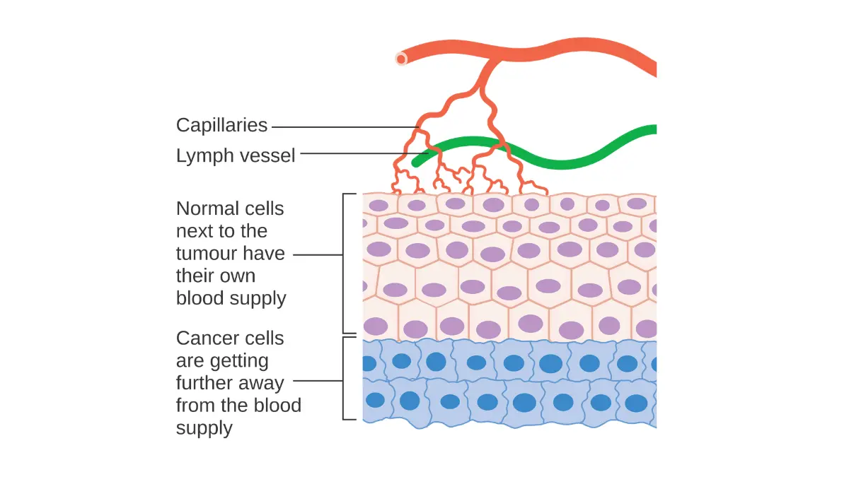 Medical vector diagram showing cancer cell angiogenesis to explain why a normal CBC does not flag early solid tumors.