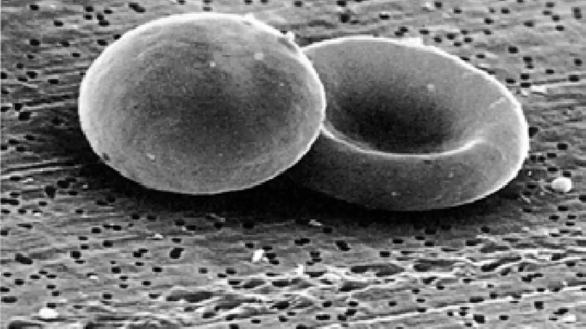 Side-by-side scanning electron microscope graphic comparing a round spherocyte to a normal discocyte cell to evaluate high MCH vs MCHC patterns.