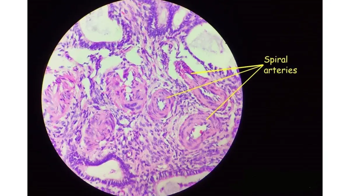 Microscopic cross-section of endometrial spiral arteries evaluating vascular risk for CMP in pregnancy