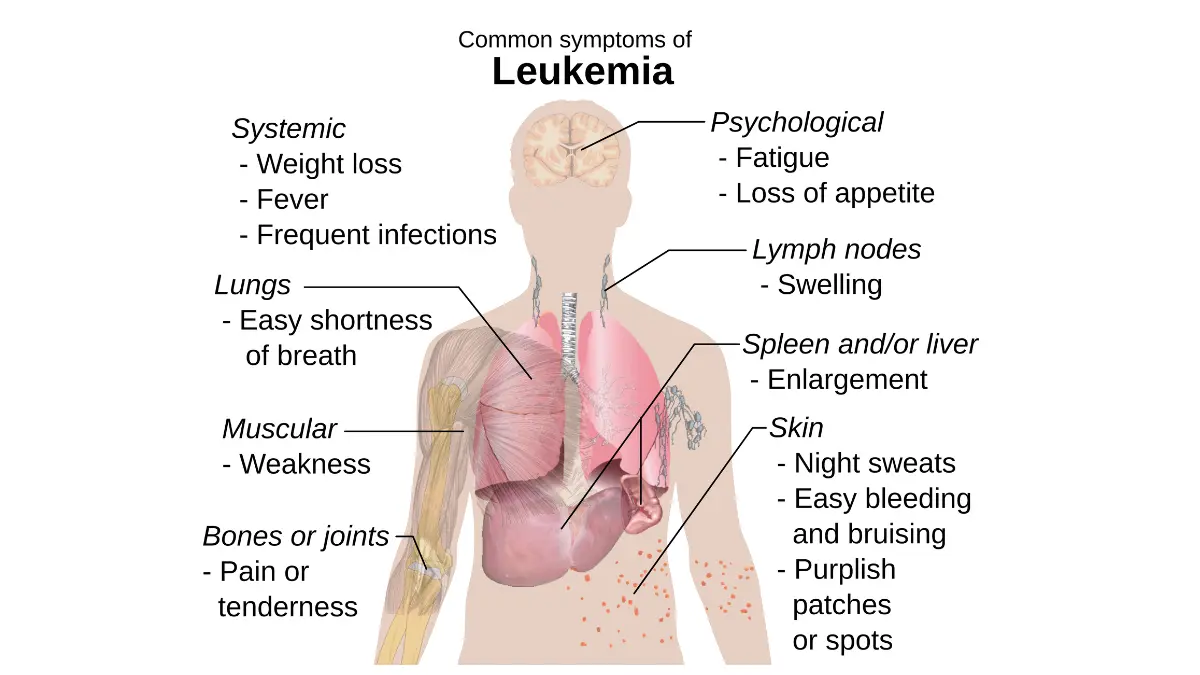 Human body outline vector map indicating regional signs including splenomegaly, swollen lymph nodes, and skin hemorrhages associated with systemic leukemia.