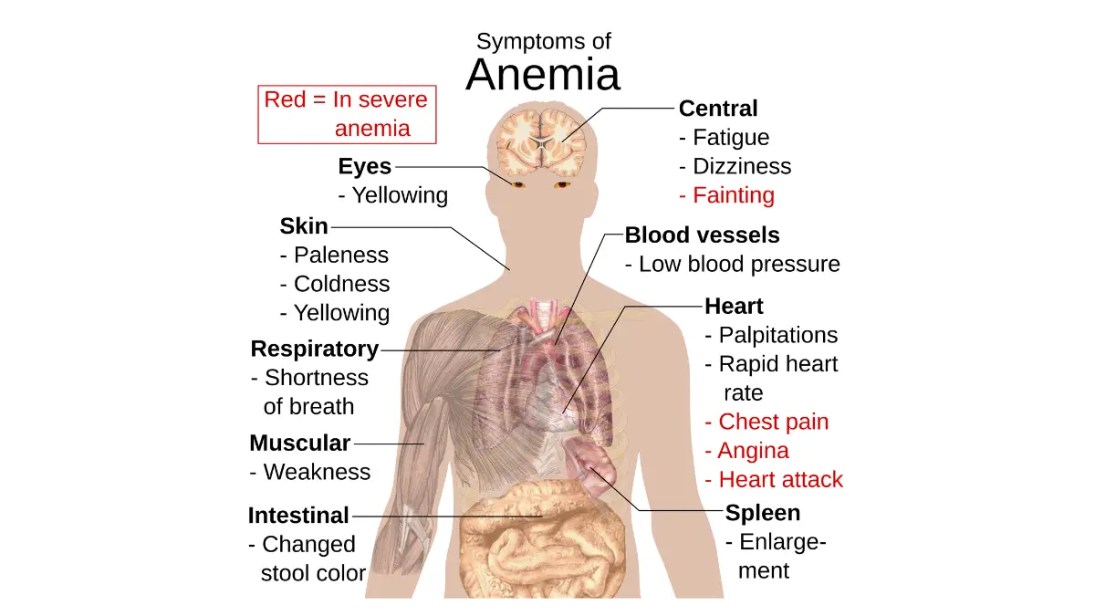An anatomical outline mapping the systemic symptoms of low hemoglobin throughout the human body, highlighting fatigue, shortness of breath, and chest pain.