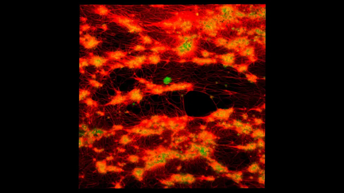 A 3D fluidic rendering showing a human blood clot mesh formed by dense cell clusters during a high platelet count event.