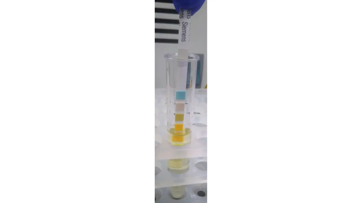 Multi-parameter urinalysis dipstick reagent strip being prepared during an Immigration or Work Physical.