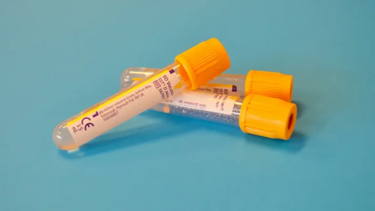 Clinical serum separator vacutainer blood collection tubes during venipuncture processing for a comprehensive metabolic panel to calculate Total Protein.